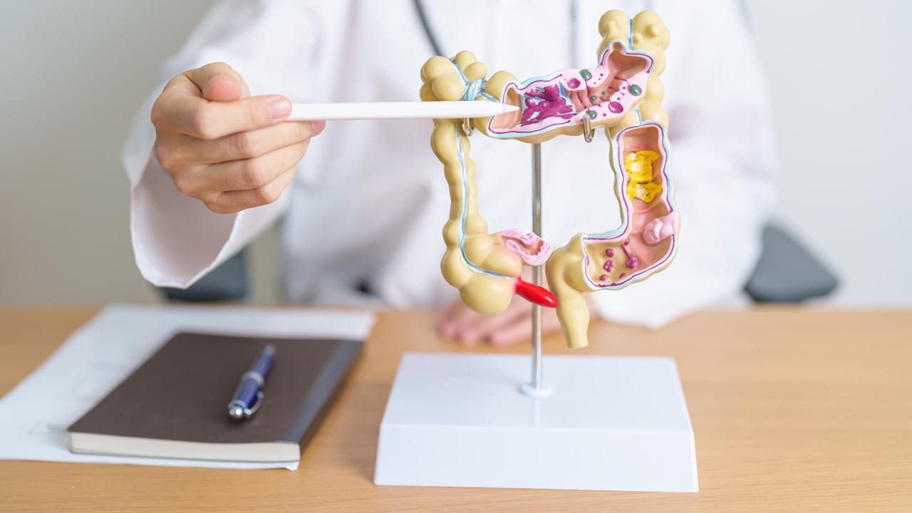 Diagnóstico precoce aumenta chance de cura de Câncer de intestino