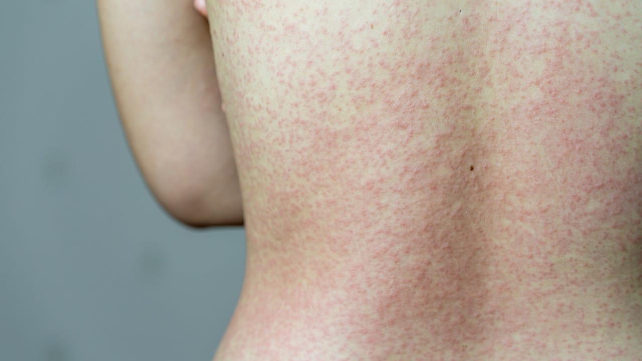 Unimed Cuiabá alerta para vacinação após casos de Sarampo confirmados em MT