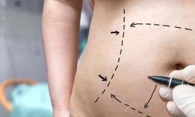 Justiça manda plano de saúde pagar cirurgia reparadora após bariátrica em Mato Grosso