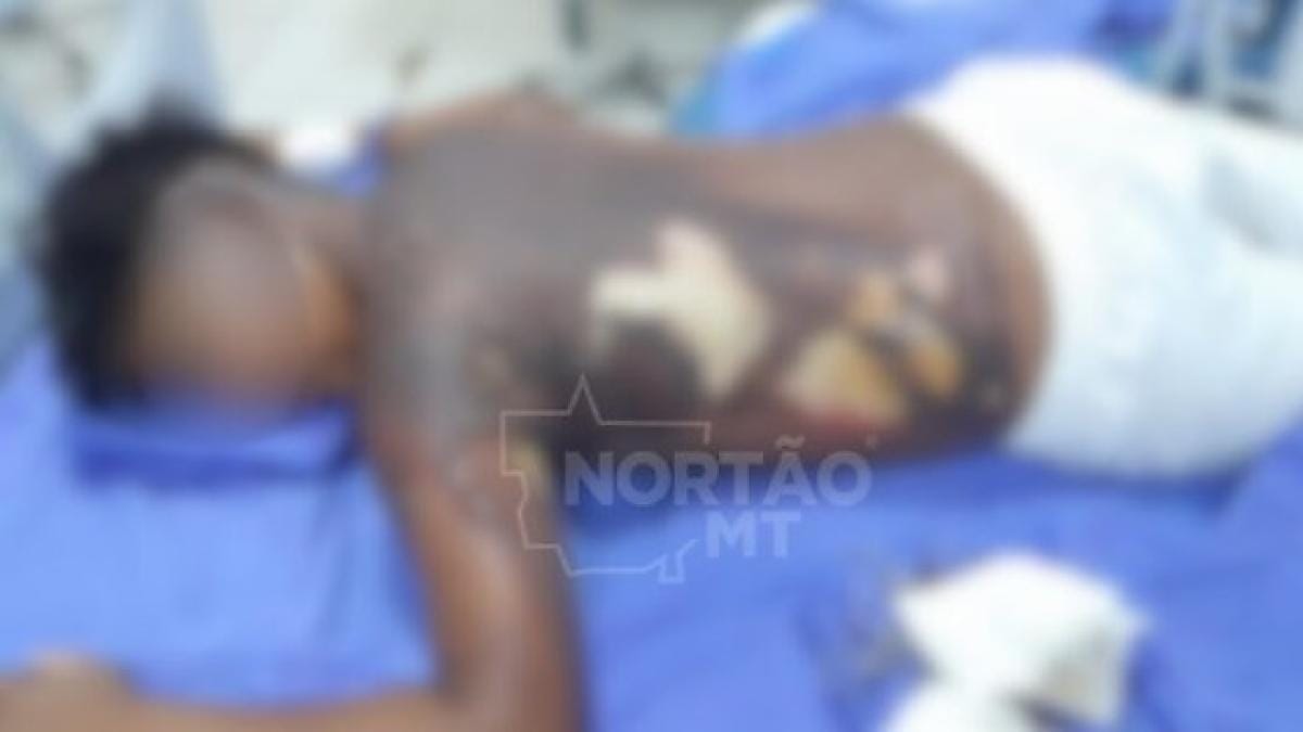 Adolescente que teve corpo queimado e foi filmado em chamas está em estado grave