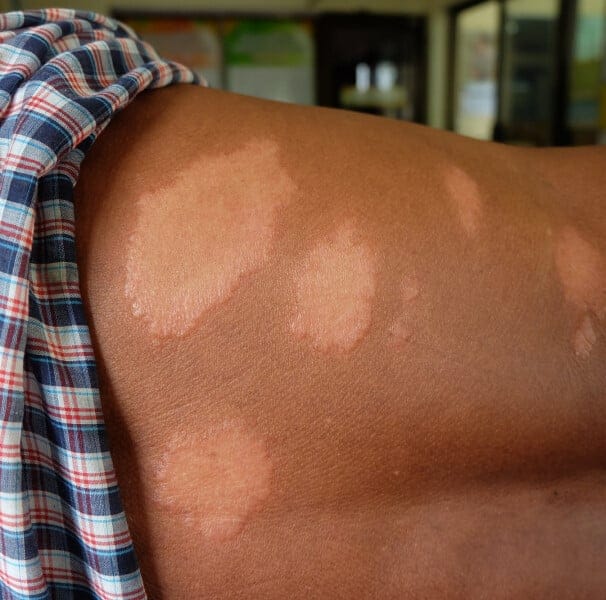 Cuiabá reforça ações de combate à hanseníase e orienta população a procurar USFs