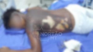 Adolescente que teve corpo queimado e foi filmado em chamas está em estado grave